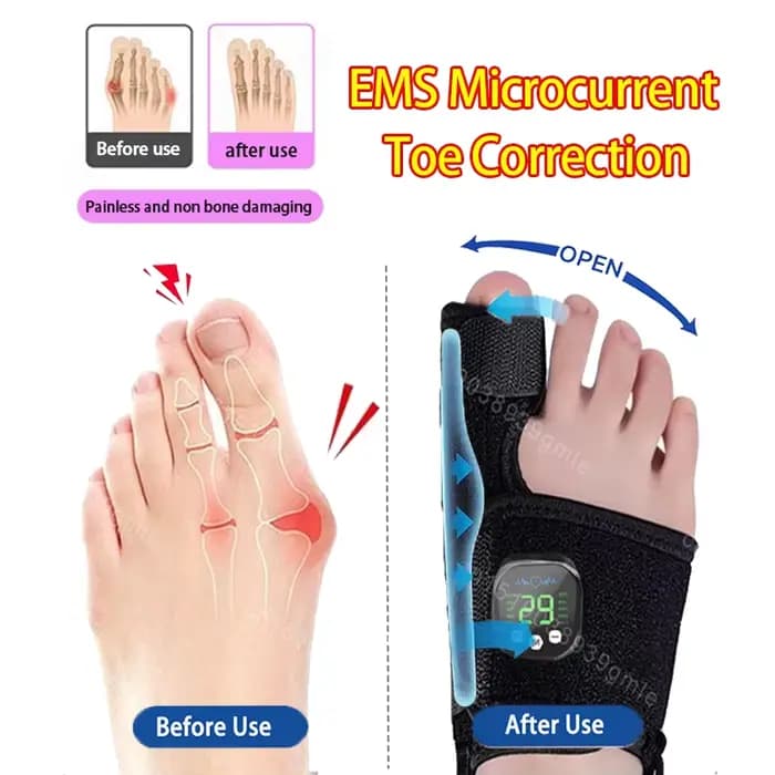 Correcteur d'hallux Valgus à microcourant Ems réglable, soins des pieds, séparateurs d'orteils, réparation de Ligament, Correction du pouce