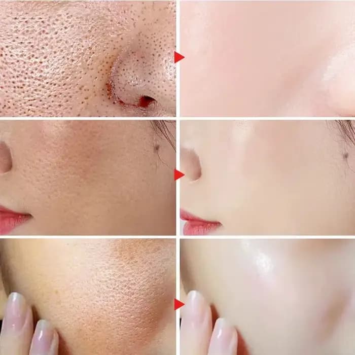 Sérum Réparateur Anti-Rougeurs Visage – Améliore la Peau Sensible et la Sécheresse – Hydratant Apaisant – Élimine la Rosacée – Cosmétiques Coréens