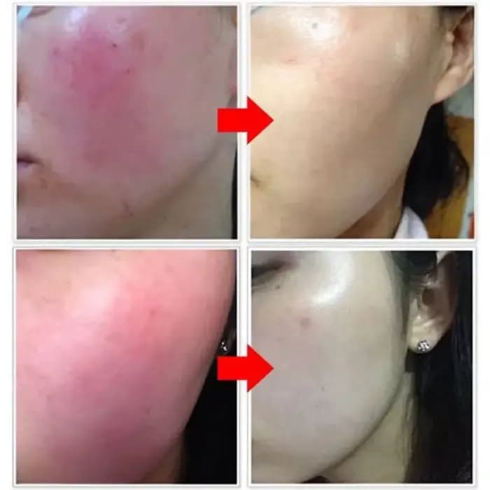 Sérum Réparateur Anti-Rougeurs Visage – Améliore la Peau Sensible et la Sécheresse – Hydratant Apaisant – Élimine la Rosacée – Cosmétiques Coréens